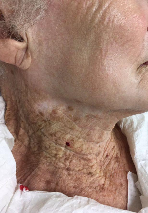 40년 동안 얼굴에만 선크림을 바른 92세 여성의 뺨과 목 피부 상태./유럽 피부과 학회지(JEADV)