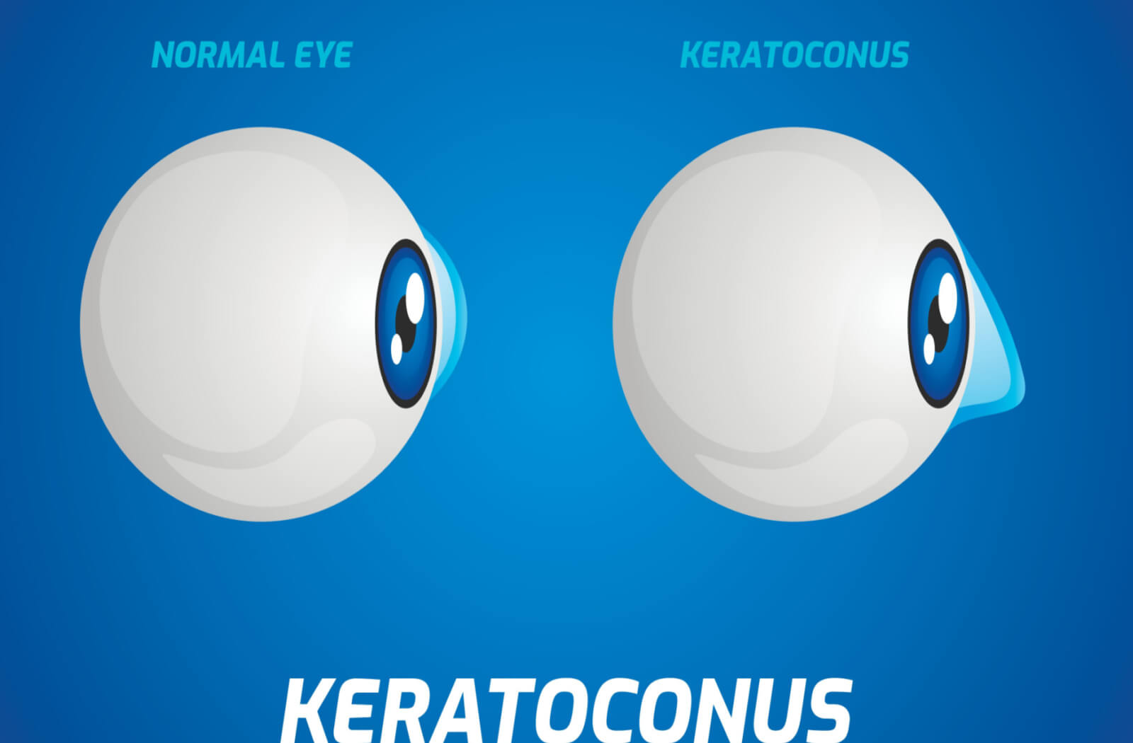 graphic depicting two eyes from the side, demonstrating a healthy eye and another with keratoconus