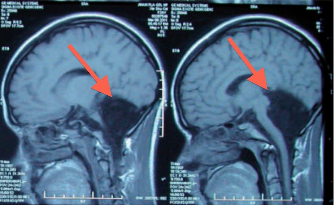 A Woman's Brain Is Missing A Cerebellum - Business Insider