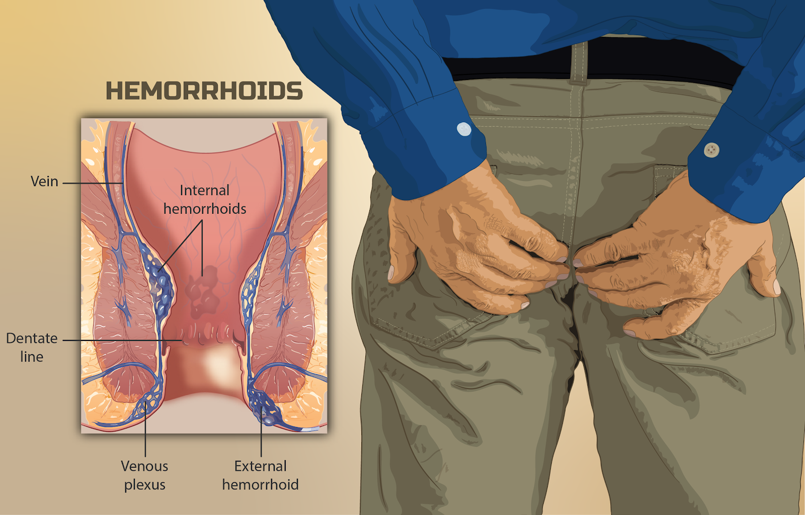 Hemorrhoid Self-Treatment Options Pharmacist Consult