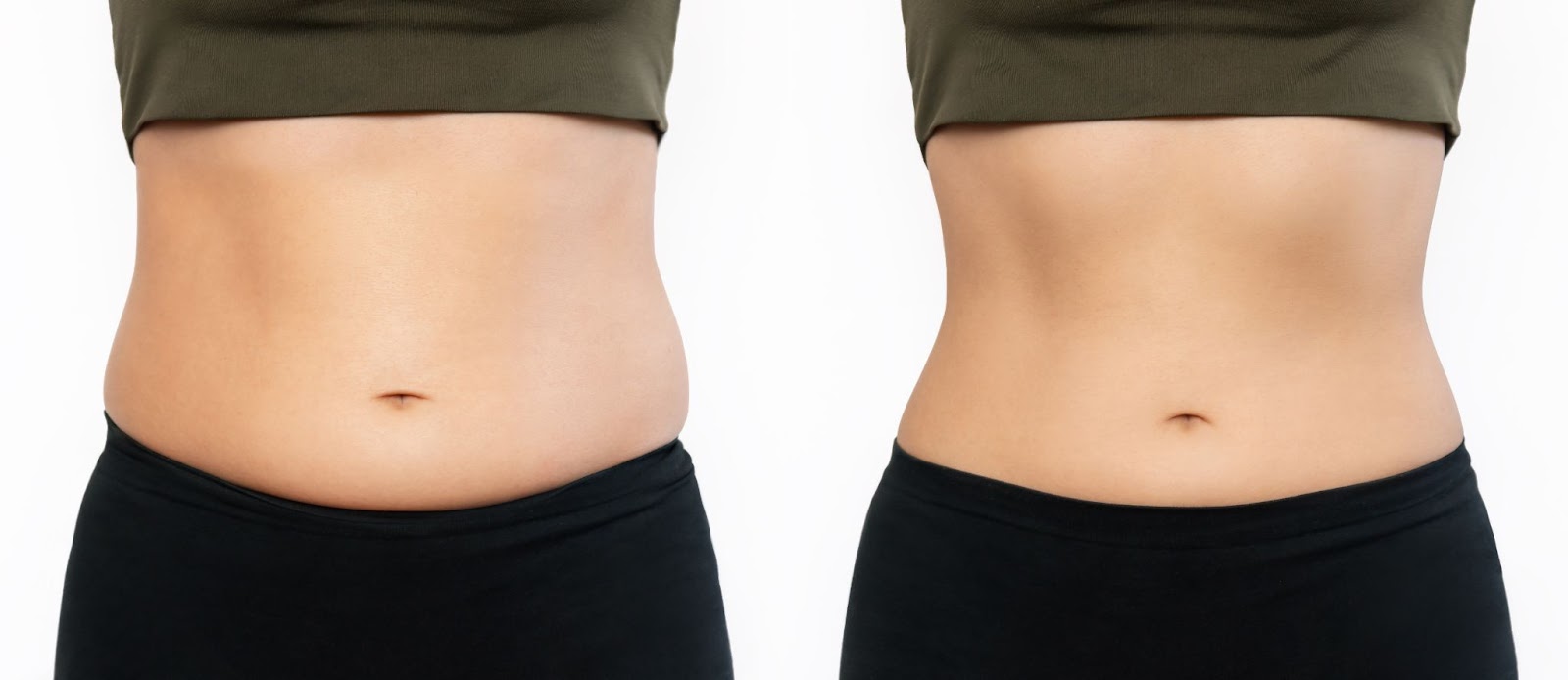 Patient 1 tummy tuck before and after 