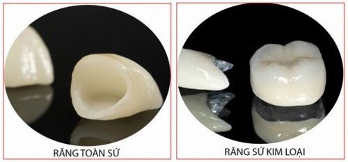 Trồng răng sứ có sử dụng vĩnh viễn được không?