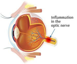 Optic Neuritis | North American Neuro-Ophthalmology Society