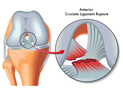anterior_cruciate_ligament_rupture