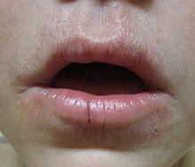 Image result for cracked lips