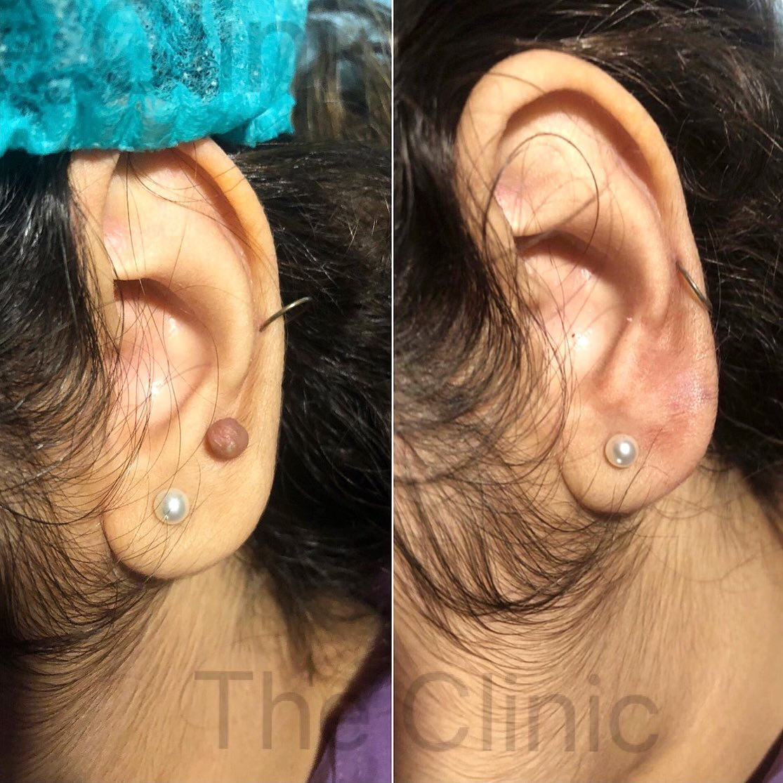 keloid therapy 