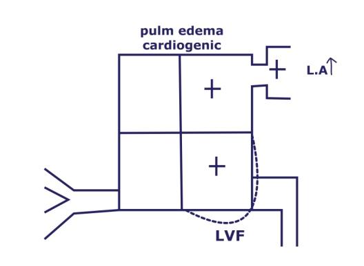pulm edema cardiogenic