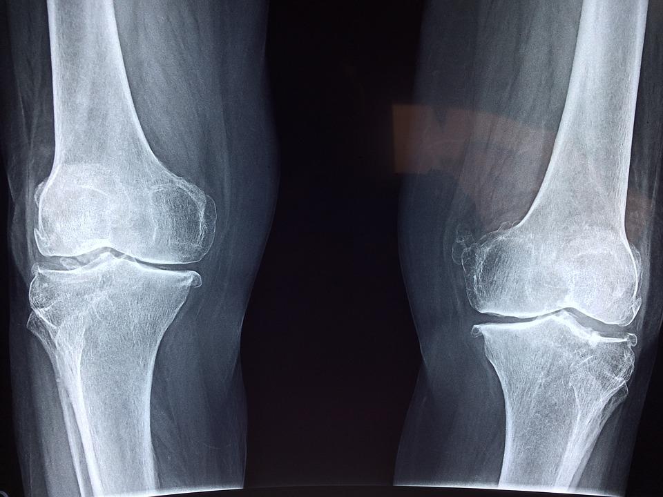 Knee, X-Ray, Medical, Anatomy, Skeleton, Bone