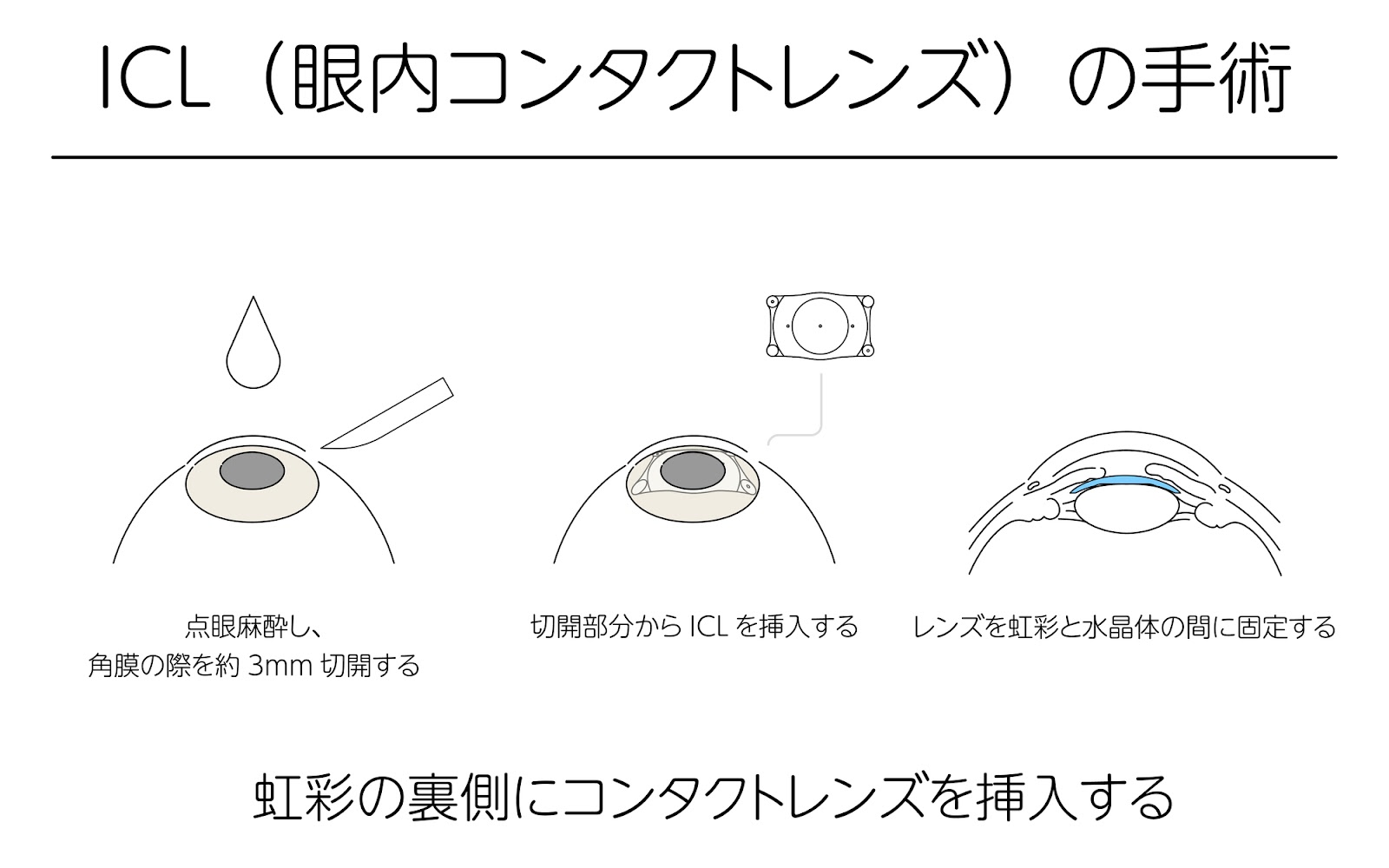 ④眼内コンタクトレンズ（ICL）にする