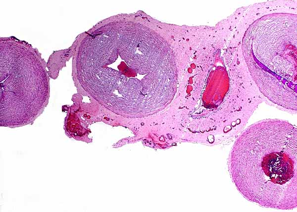 Four blood vessels in the umbilical cord with a central allantoic duct. This one happens to contain blood from delivery. Note the many smaller vessels in the cord
