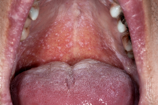 ไลเคนพลานัสในช่องปาก
