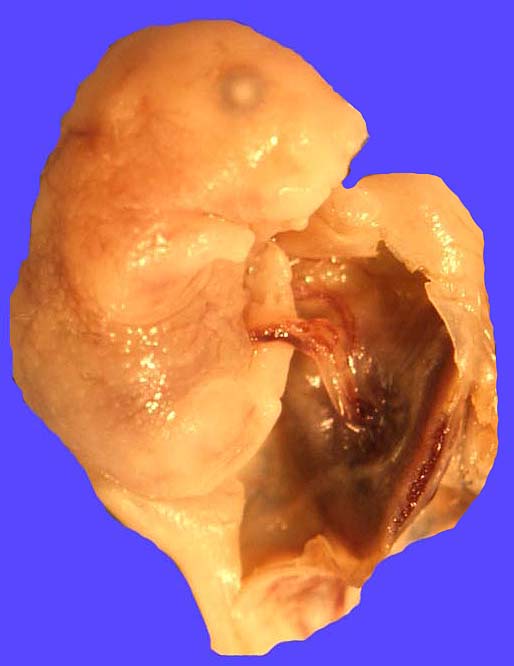The placental disk is at the right and the embryo is attached to it with the delicate umbilical cord seen in the center.