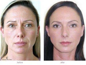 Before & After Botox Anti-Wrinkle Injections