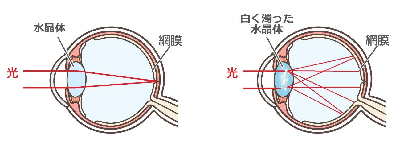 モノが2つ・3つに見える（複視）