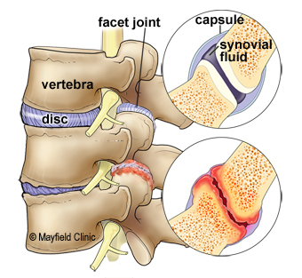 Facet Joint syndrome can be a source of pain anywhere in the spine. Facet joint syndrome is due to poor posture, awkward sleeping positions, and trauma. 