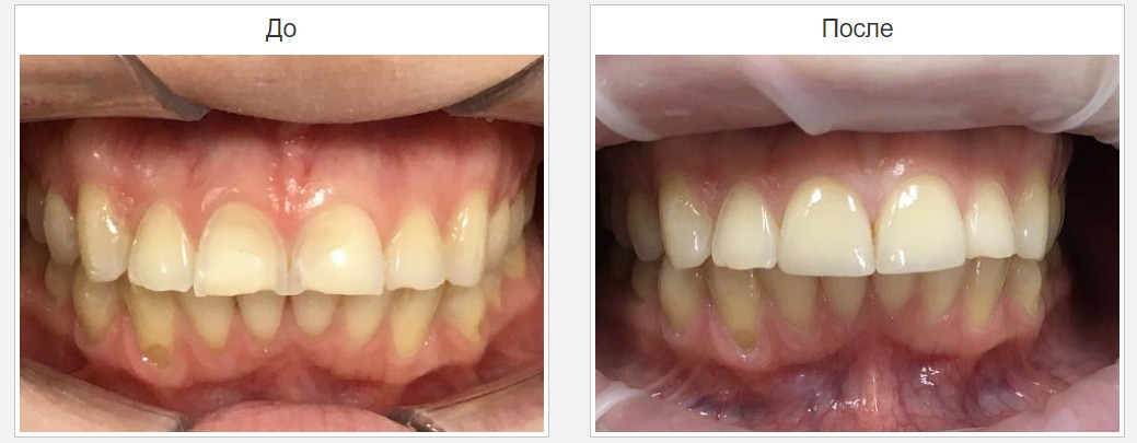 стоматологическое протезирование зубов