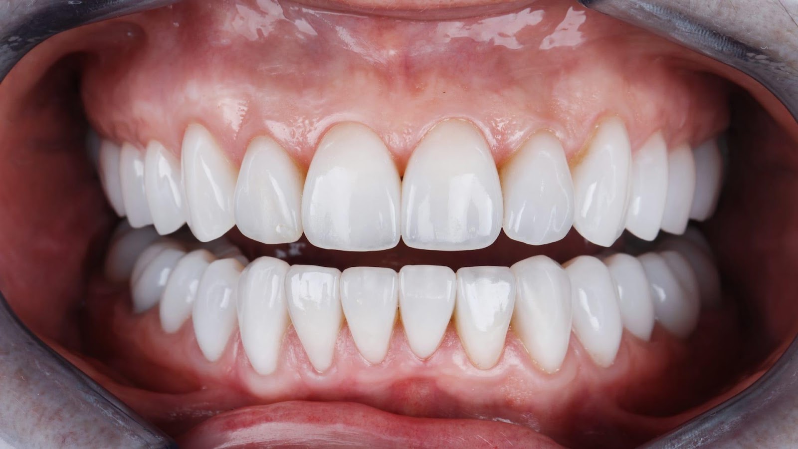 dental veneers in North York