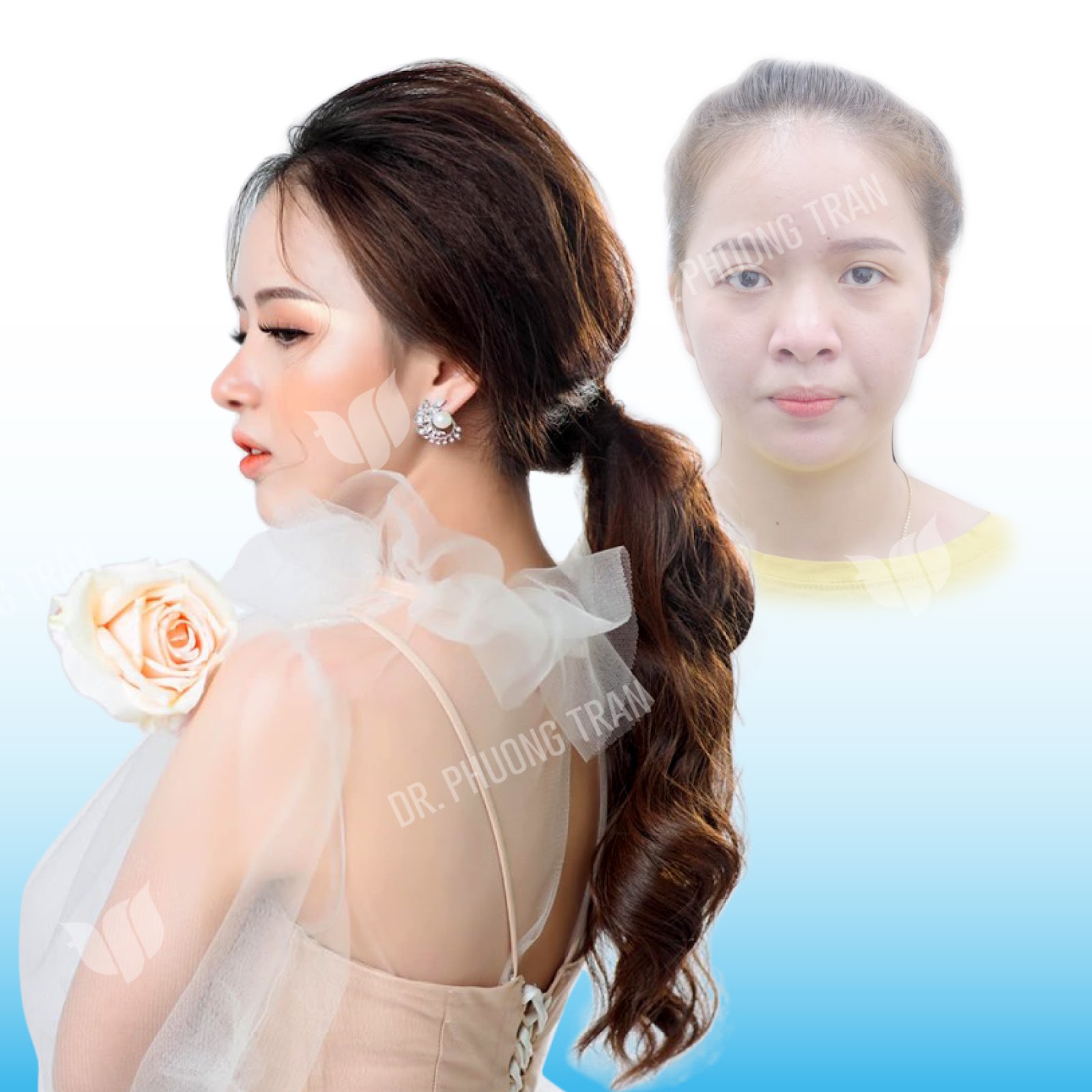 4 dấu hiệu cho thấy nâng mũi bọc sụn Megaderm thành công mỹ mãn