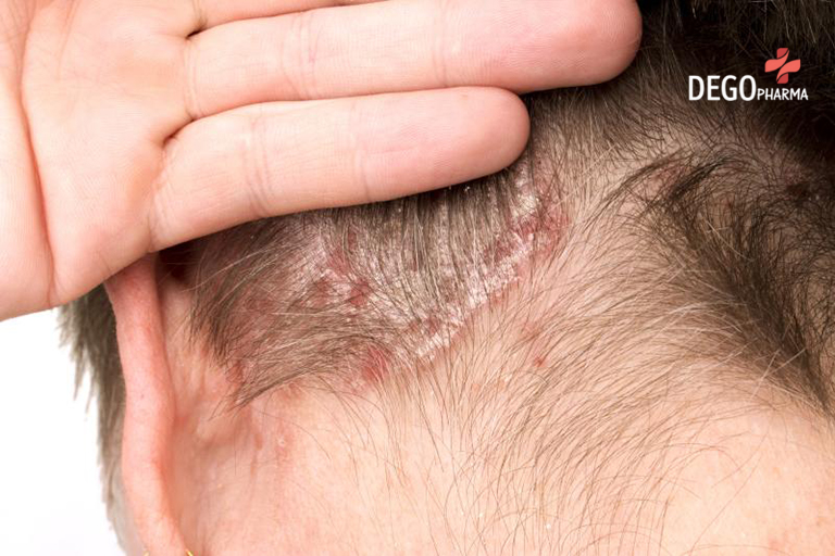  Vảy nến da đầu tuy không lây nhưng lại là bệnh có tính di truyền