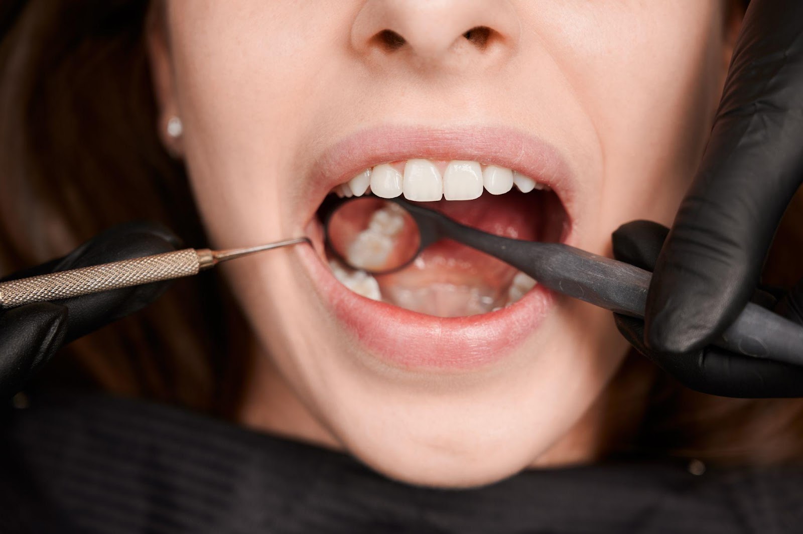 定期進行洗牙可改善牙周病病況