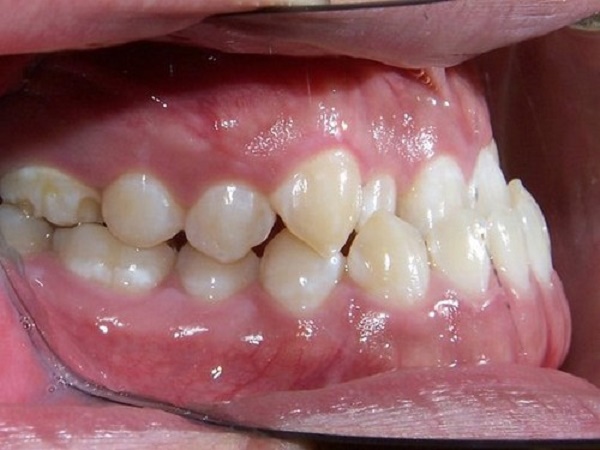 Niềng răng hàm móm
