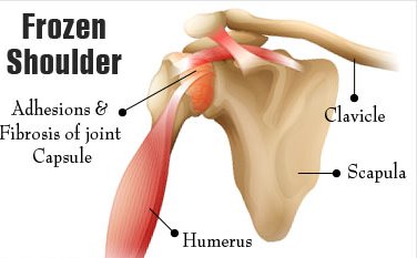 87 Minute Can you use a tens unit after shoulder surgery Sets