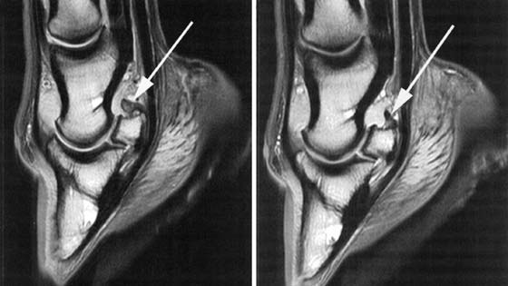 These are sagittal PD images from a horse with a thickened proximal suspensory ligament of the NB.