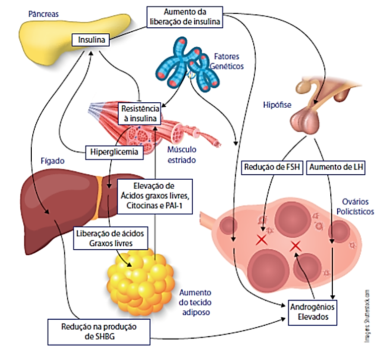 Conceitos básicos sobre síndrome dos ovários policísticos | Colunistas -  Sanar Medicina