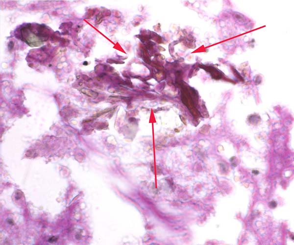 Cluster of branching fungi in term bontebok placenta (PAS)