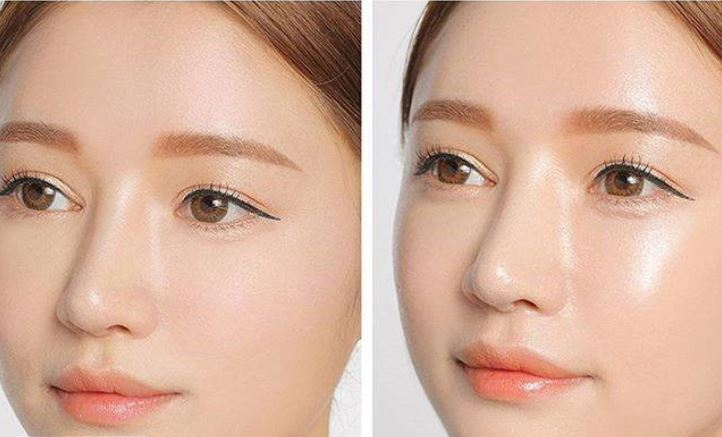 Before and After of BB GLow Treatment 