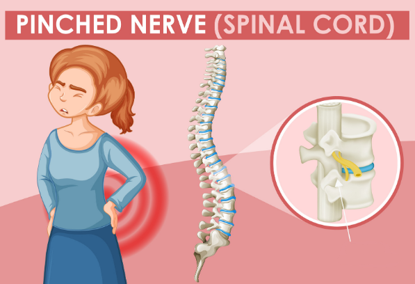 What Causes a Pinched Nerve &amp; How Chiropractic Can Help