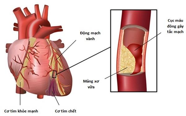 Xơ vữa động mạch vành gây biến chứng nguy hiểm đến tim. 