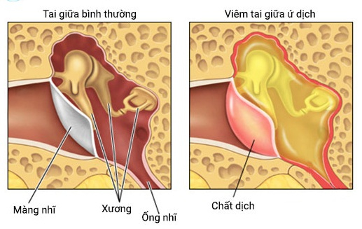 viêm tai giữa