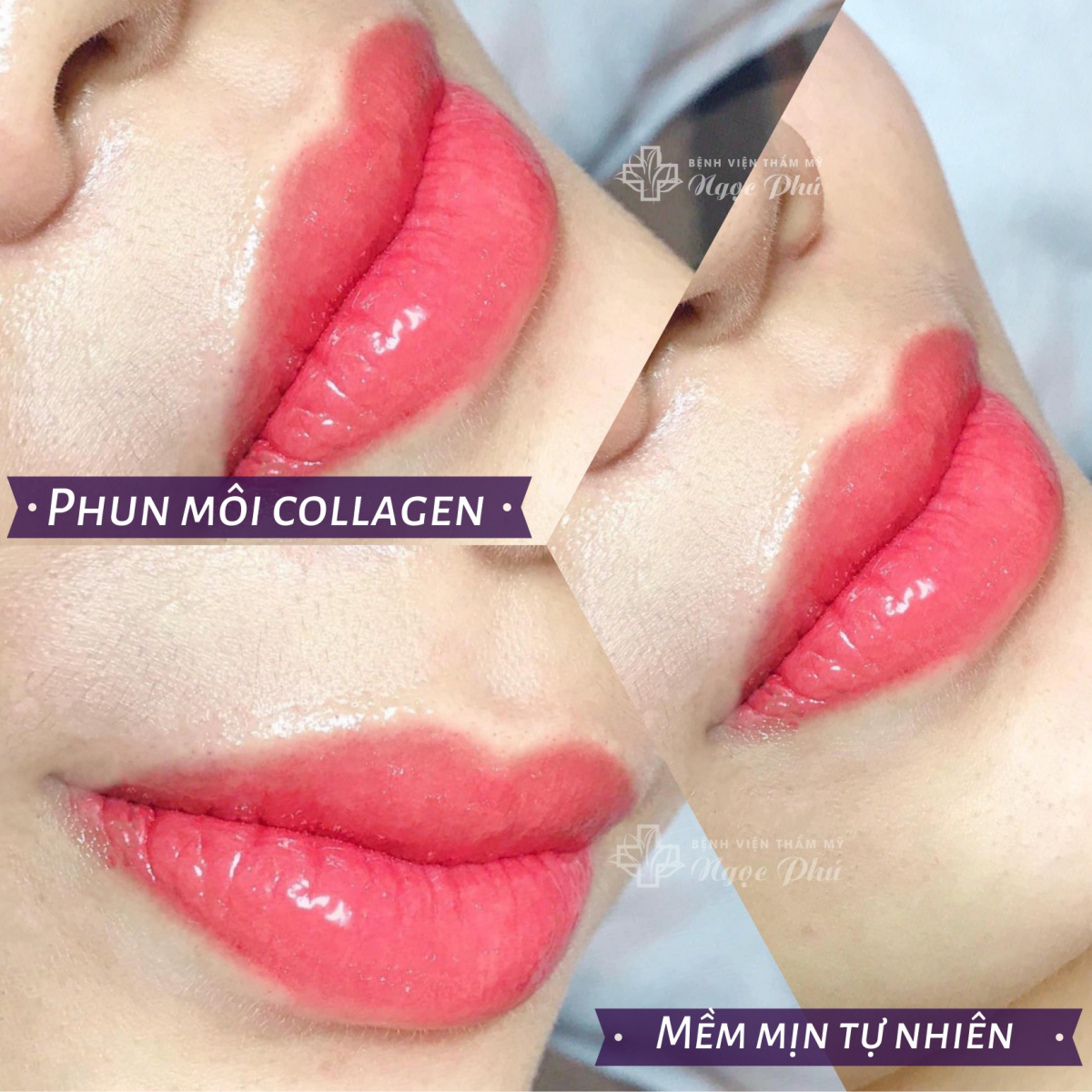 Phun môi Collagen tại Thẩm Mỹ Việt Nam