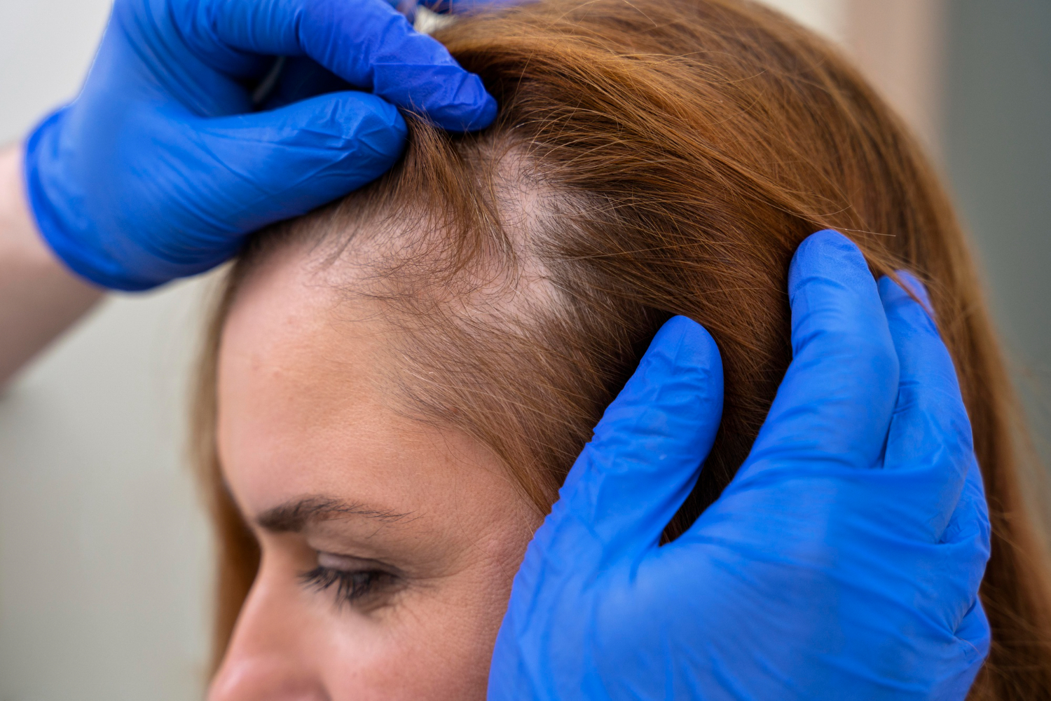 الفيناسترايد لعلاج تساقط الشعر لدى النساء