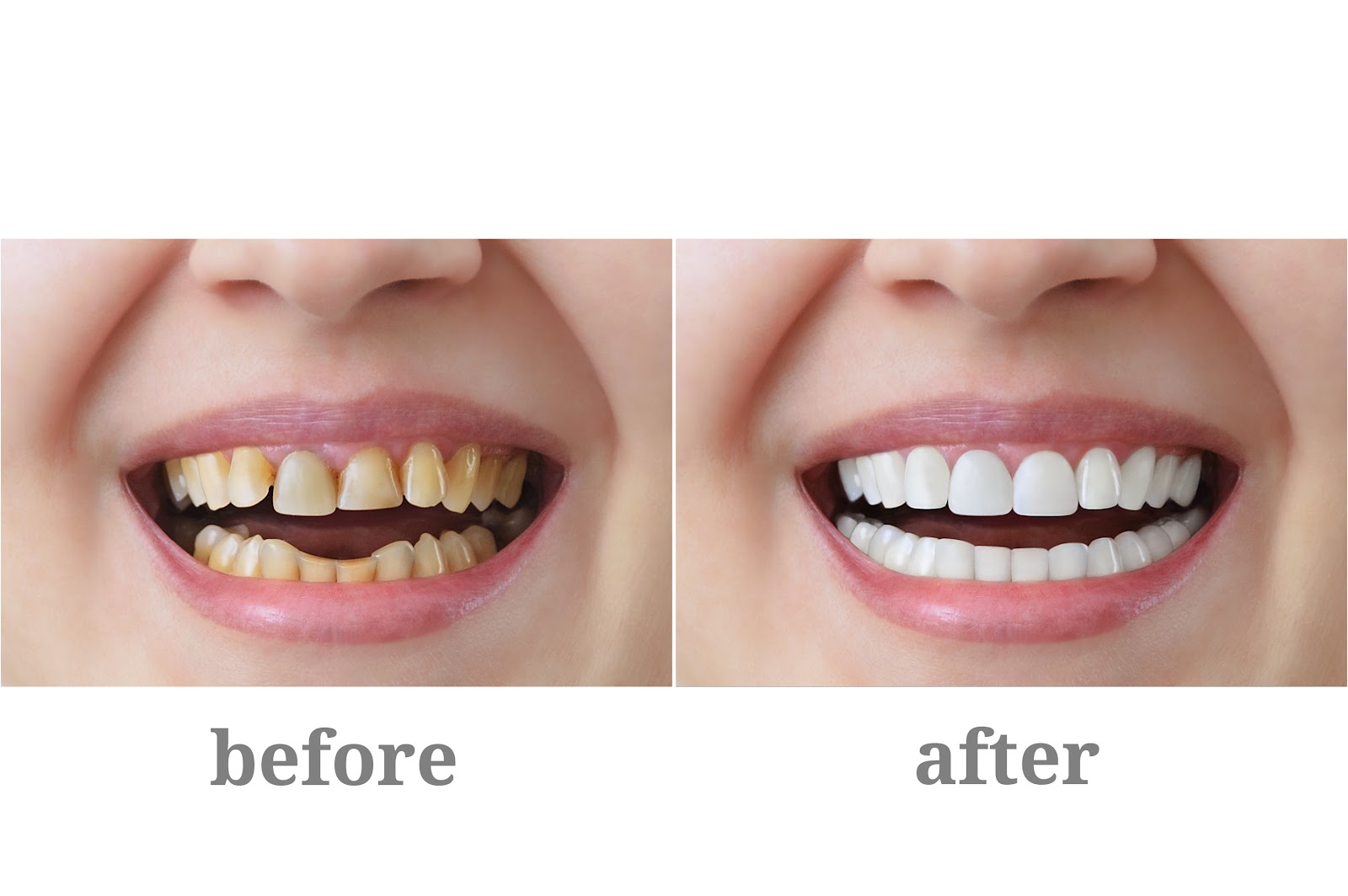 Porcelain Crowns & Porcelain Bonded Crowns - Treatment, Care & Advice