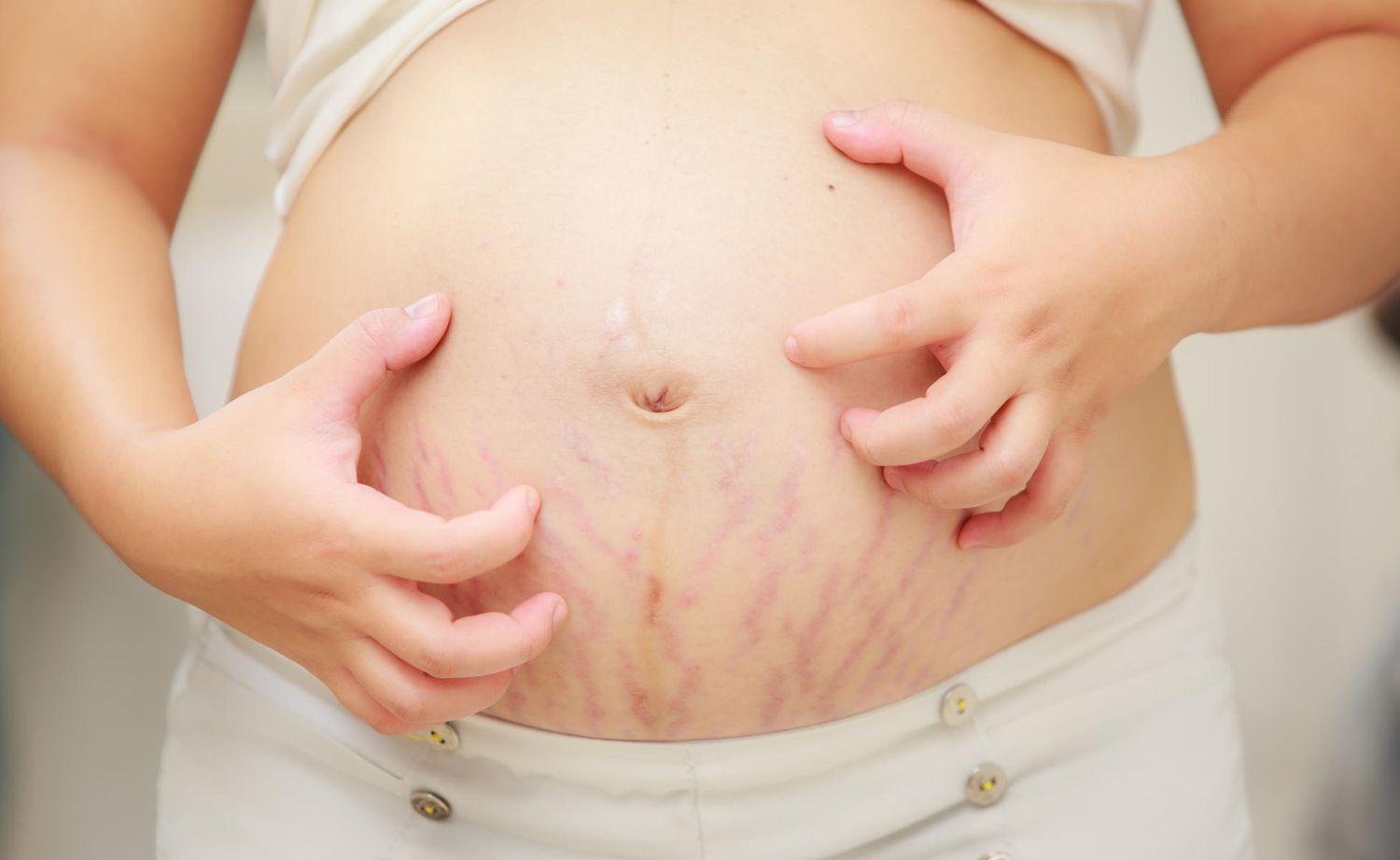 Pregnancy Rash: What is PUPPPs?