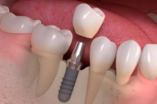  So sánh trồng răng Implant và bọc răng sứ