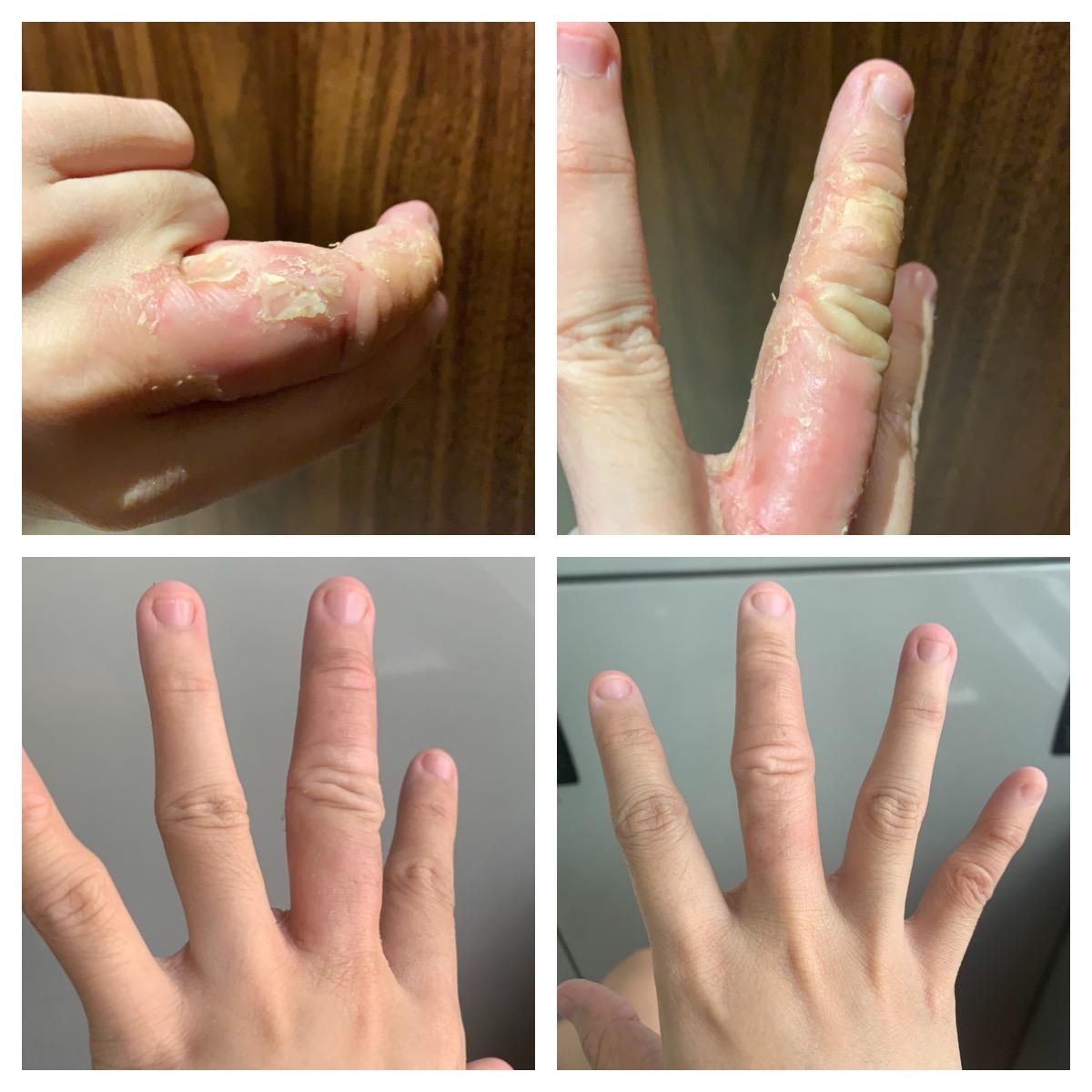 Eczema before and after using Omega369 emu oil and Kakadu Ointment. The bottom image shows that her skin redness has gone down, her skin has stopped flaking and peeling, and swelling appears visibly reduced.