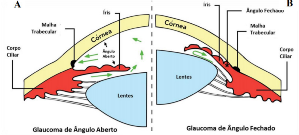 Representações do Glaucoma de ângulo aberto e fechado