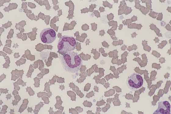 Feline blood. Increase in band neutrophils indicates a severe left shift. Increased rouleaux formation can be caused by changes in plasma proteins as a result of inflammation (40x)
