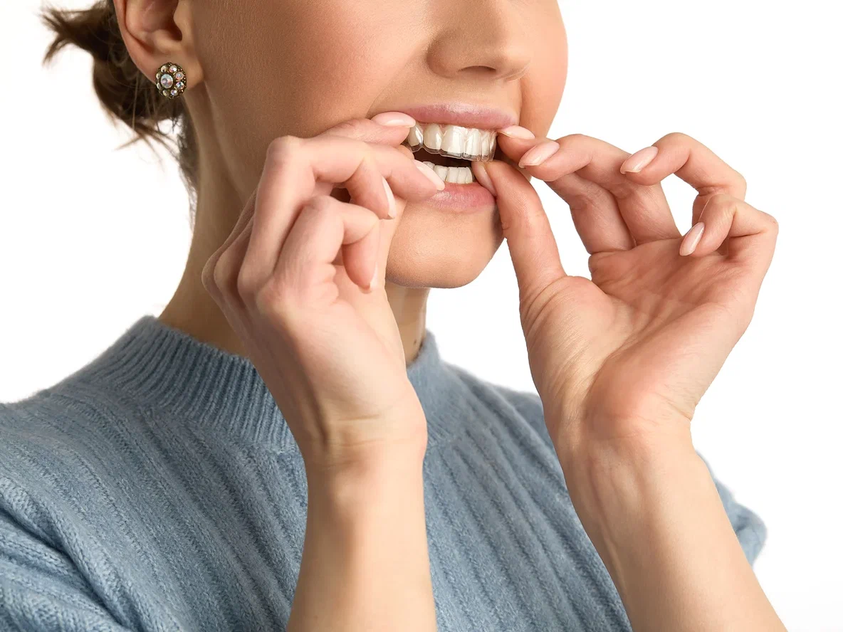 Каппа для зубов: что это такое и как она работает?