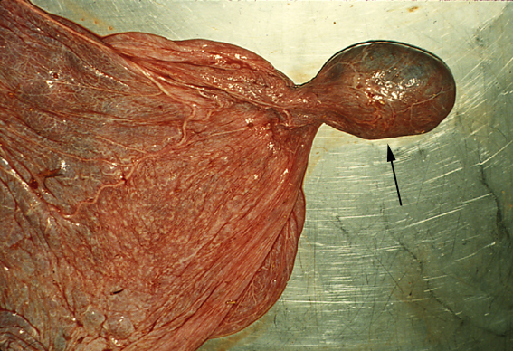 Fetal mummy present as an invaginated sac in the allantoic cavity of the remaining normal singleton placenta at term (arrow).