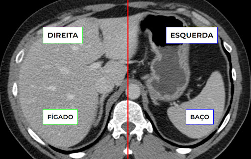 Acima, esquema de como vemos as imagens na tomografia, a partir dos pés do paciente. Embaixo, tomografia em que vemos o lado esquerdo do paciente como direito e vice-versa. Notem a localização do fígado e do baço na imagem.  Fonte: Arquivo pessoal.