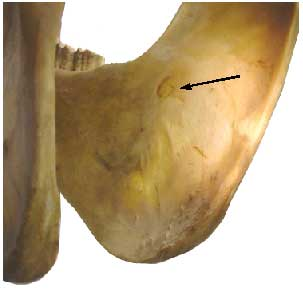 Mandibular foramen. 