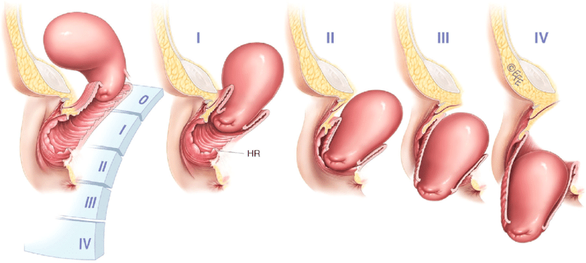 shows prolapse staging 4-0, I, II, III, IV. (uterine-by the position of... | Download Scientific Diagram