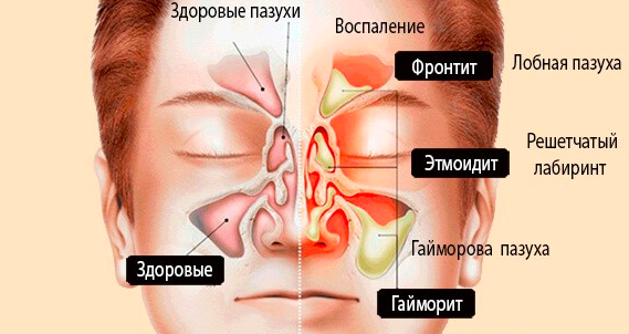 Синусит можно греть нос