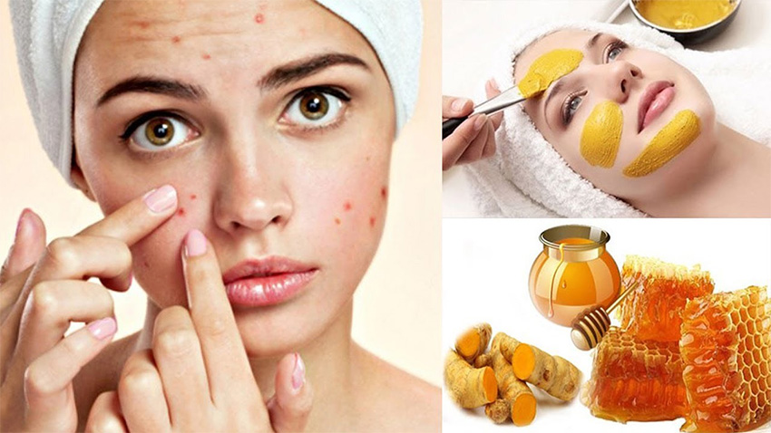 Mật ong Manuka kết hợp nghệ tươi/ bột nghệ giúp loại bỏ nhanh chóng mụn trứng cá