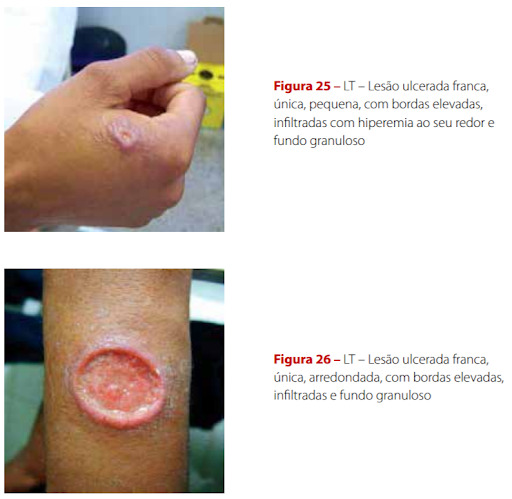 Imagem ilustrativa - tratamento da leishmaniose tegumentar