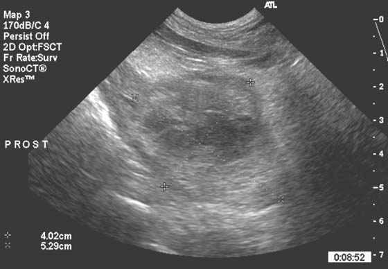Sonogram of the prostate (longitudinal view) of a 6 year old intact male Australian cattle dog that presented with fever, lethargy, stranguria, hemolytic anemia, and thyrombocytopenia resulting from a prostatic abscess